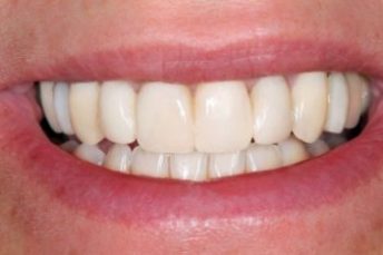 cosmetic dentistry after 1 croydon