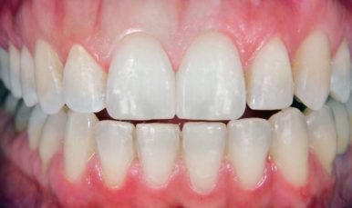 cosmetic dentistry after 2 croydon