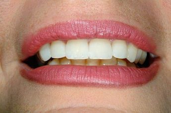 cosmetic dentistry after 4 croydon