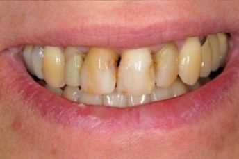 cosmetic dentistry after 1 croydon