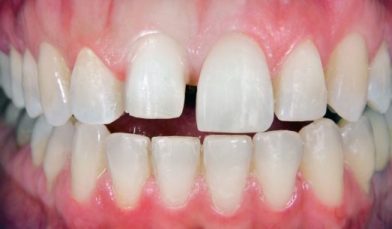 cosmetic dentistry after 2 croydon