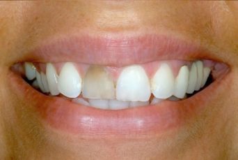 cosmetic dentistry after 3 croydon