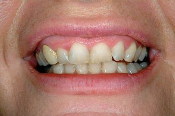 cosmetic dentistry after 4 croydon