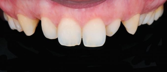 cosmetic dentistry after 6 croydon