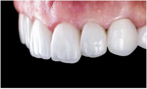 dental implant after 2 croydon