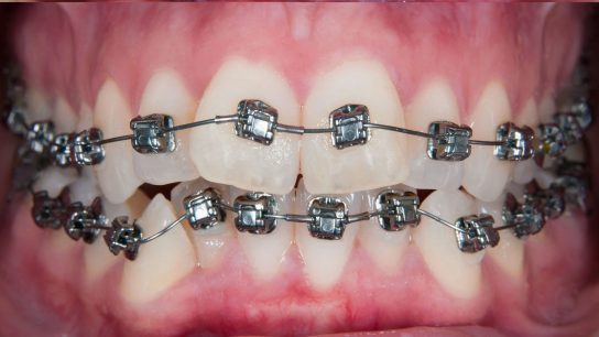 orthodontics after 1 croydon
