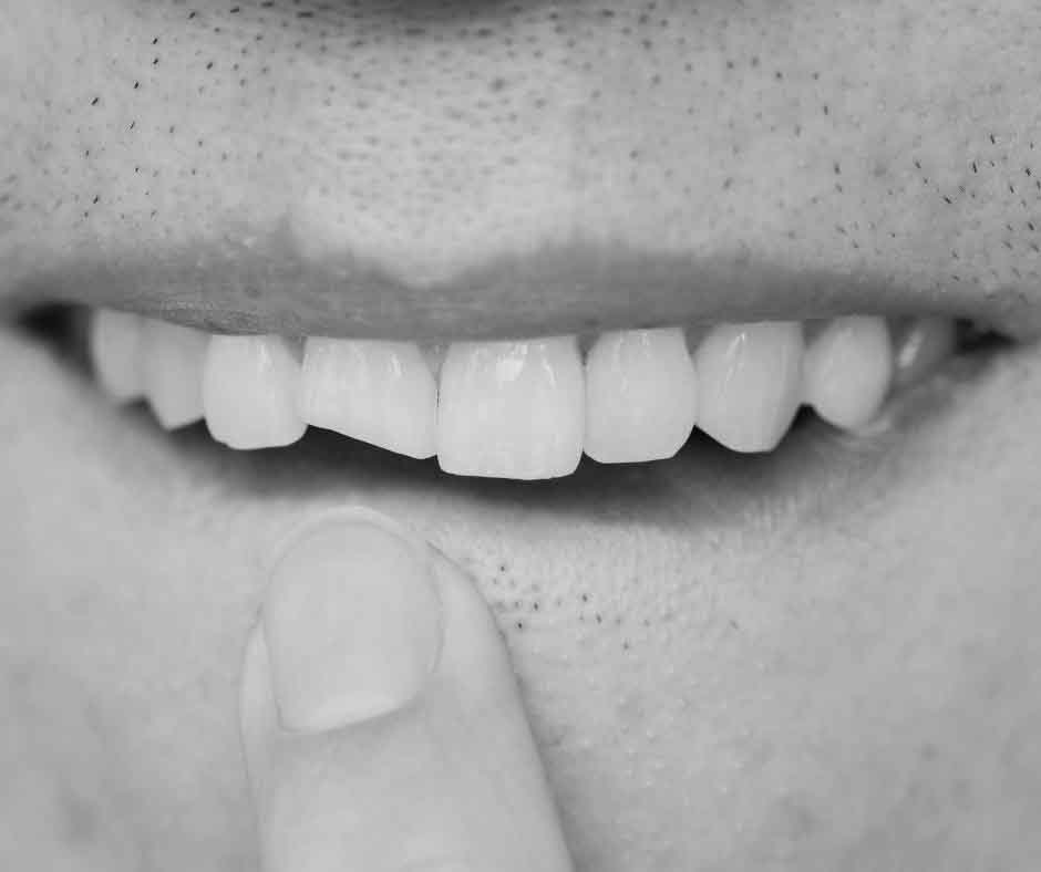 Chipped Tooth Treatment Croydon Dentist