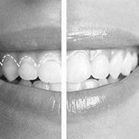 Dental-Treatment-Braces or Invisalign