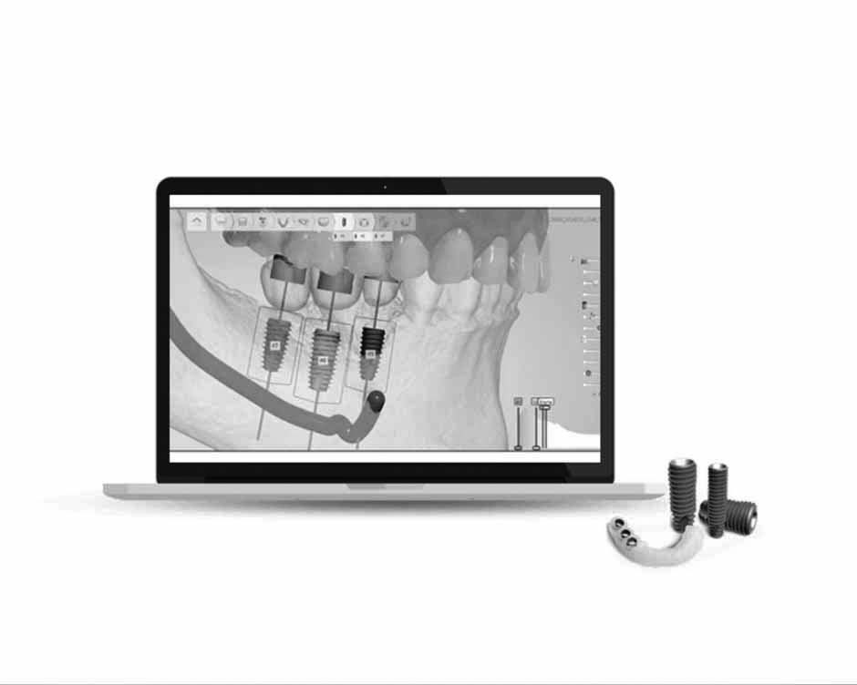 Digital Guided Implant Surgery