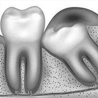 Impacted Teeth/Wisdom Teeth Removal Smile Crew Dentist Croydon