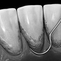 Periodontitis