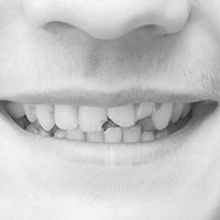 Chipped Cracked Tooth Treatment Croydon dentist