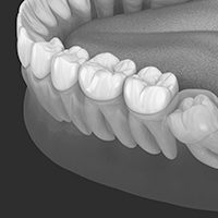 Impacted Wisdom Tooth Removal Croydon
