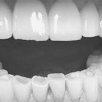 Worn Down Teeth treatment Croydon